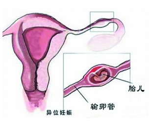 成都看宫外孕的医院