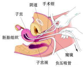 成都女性不当人流对身体有什么影响